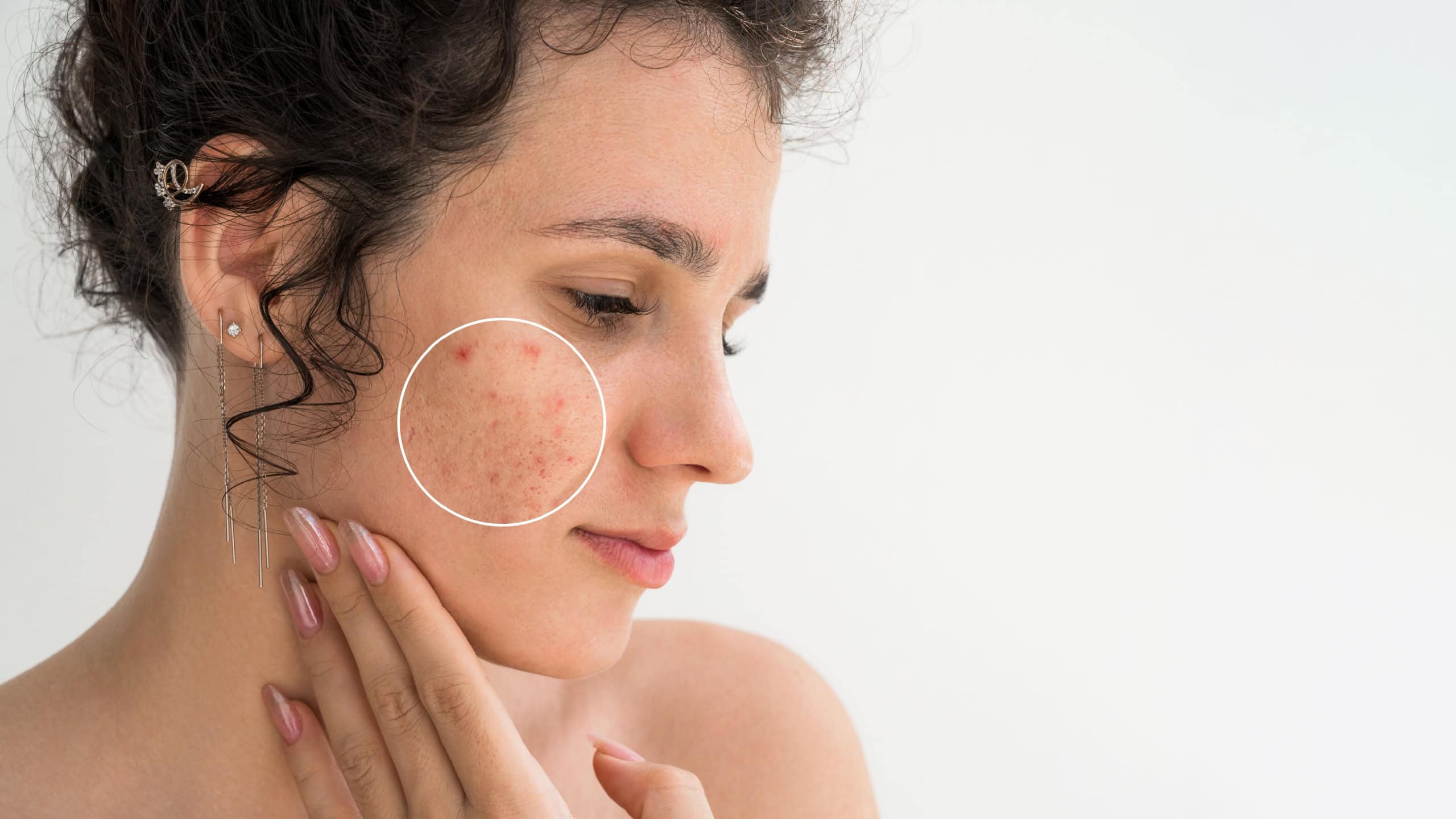 Portrait of a young girl with pimples and acne on face close up on white background. Woman with problematic skin. Collage of problem skin before and after treatment and care